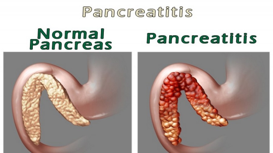 Панкреонекроз